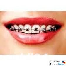 Aparat dentar safir Bucuresti