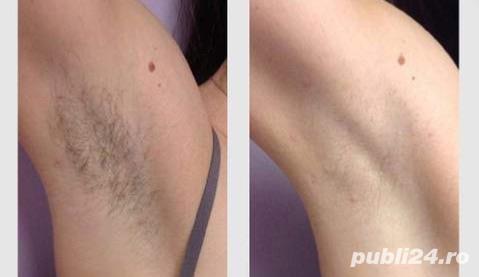 Epilare definitiva,Fotoregenerare(tratamente faciale și corporale cu laser