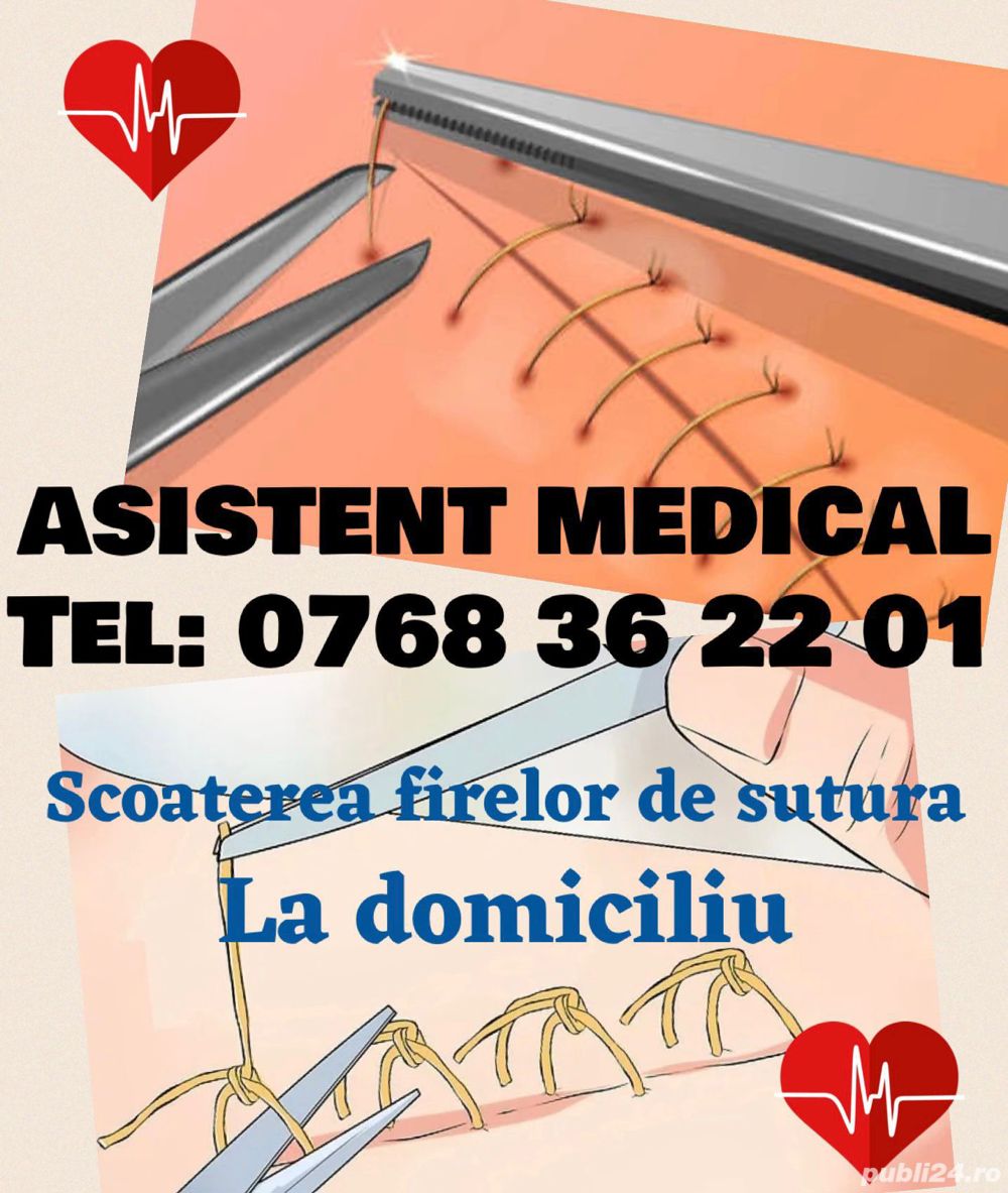 Scoaterea firelor la domiciliu după operatie în București și Ilfov 