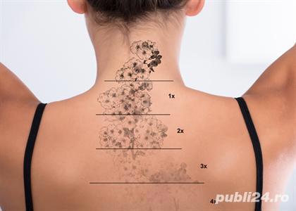 Stergere tatuaje, cu laser picosecond