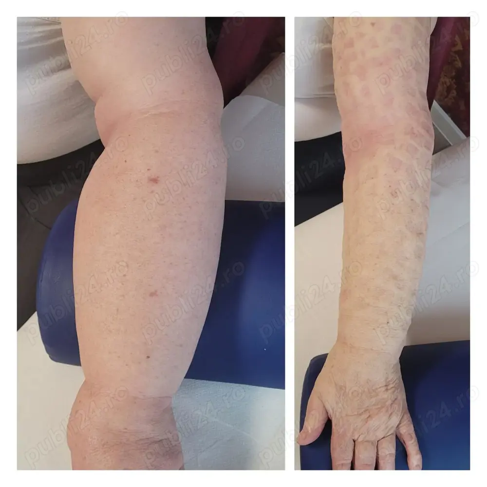 Drenaj Limfatic Manual in diverse afectiuni,la domiciliul pacientilor