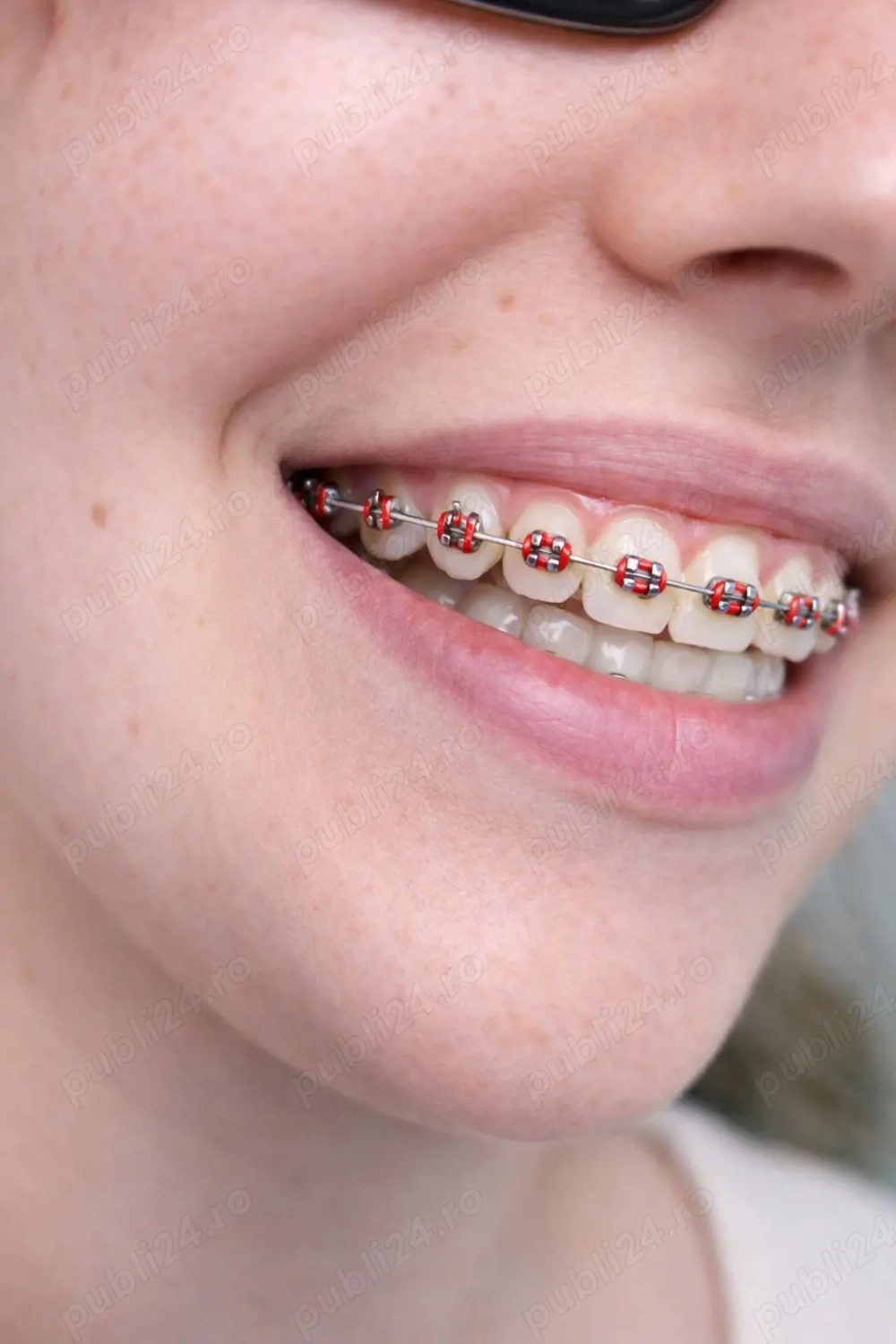 Aparate Ortodontice Metalice și Safir   Dr. Maxim | Sector 3 București