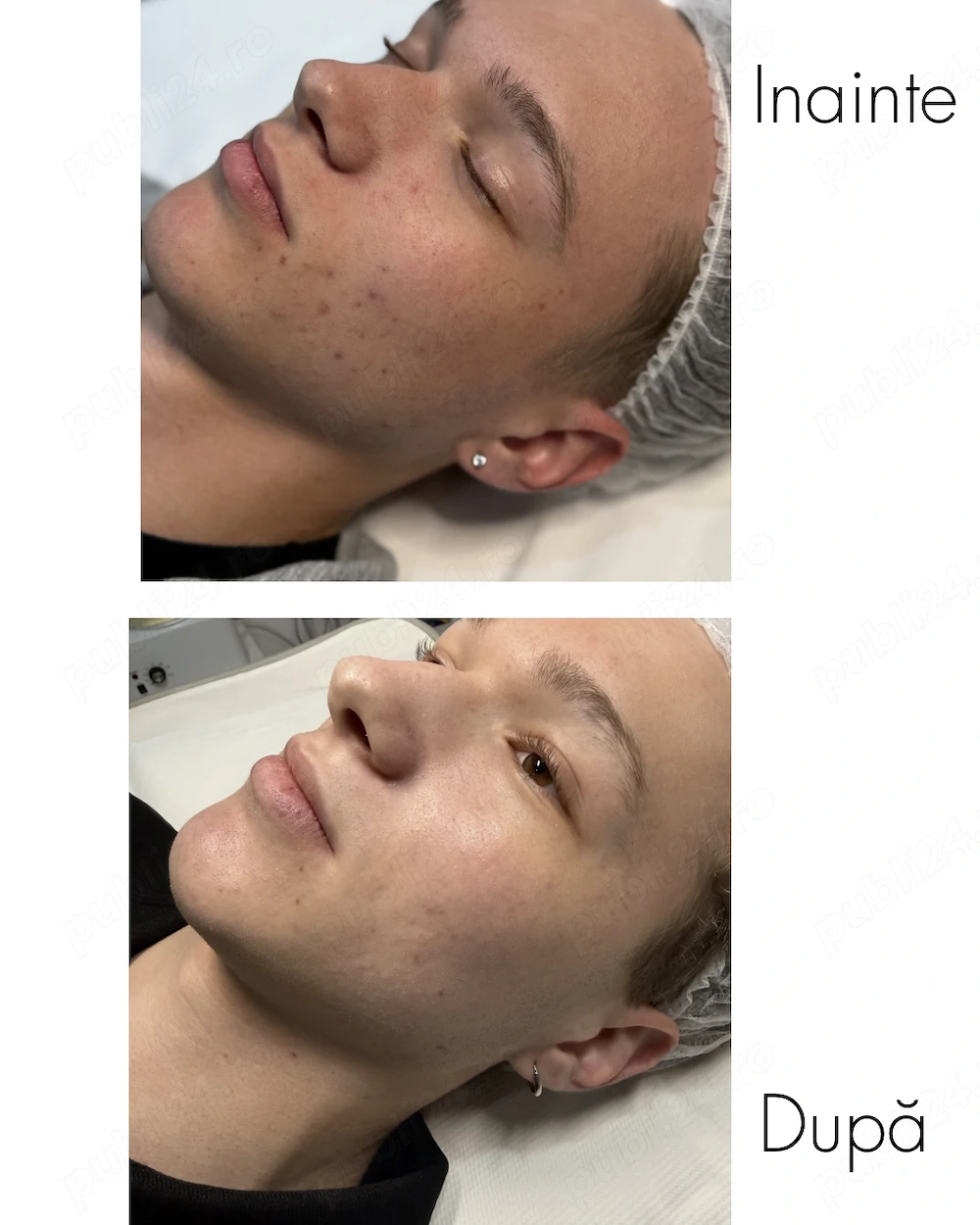 Tratament acnee -Piața Unirii 