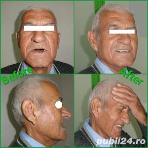 Proteze dentare acrilice în regim de URGENȚĂ