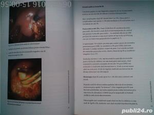 Colecistectomia laparoscopica in circumstante speciale, Horea Radu , 2005 - imagine 10