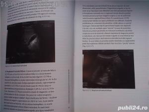 Colecistectomia laparoscopica in circumstante speciale, Horea Radu , 2005 - imagine 9