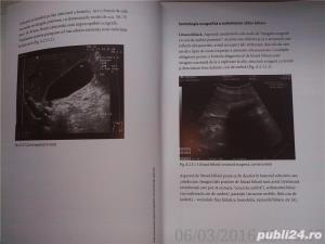 Colecistectomia laparoscopica in circumstante speciale, Horea Radu , 2005 - imagine 8