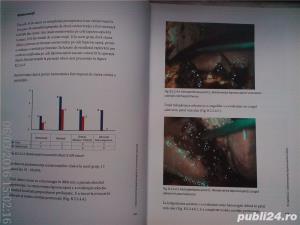 Colecistectomia laparoscopica in circumstante speciale, Horea Radu , 2005 - imagine 14