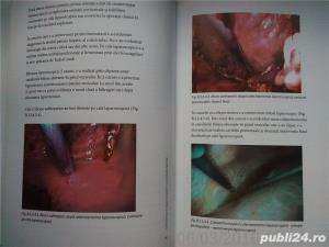 Colecistectomia laparoscopica in circumstante speciale, Horea Radu , 2005 - imagine 16