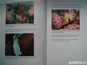 Colecistectomia laparoscopica in circumstante speciale, Horea Radu , 2005 - imagine 15