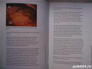 Colecistectomia laparoscopica in circumstante speciale, Horea Radu , 2005 - imagine 17