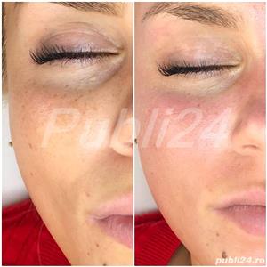 Mezoterapie cu ace pentru lifting si atenuarea ridurilor