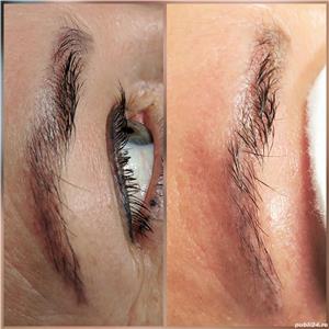 Indepartare tatuaje - imagine 1