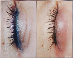 Indepartare tatuaje - imagine 4