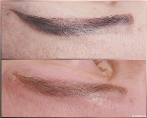 Indepartare tatuaje - imagine 5