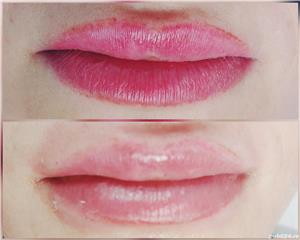 Indepartare tatuaje - imagine 3