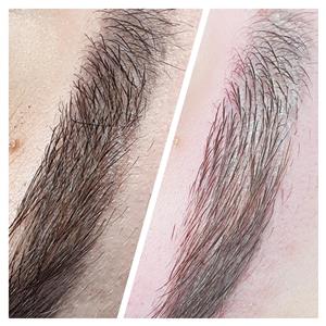 Indepartare tatuaje - imagine 2