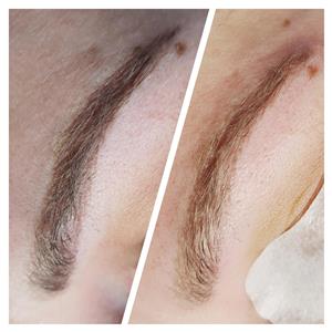 Indepartare tatuaje - imagine 6