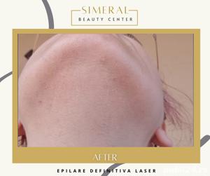 Epilare definitiva laser Brasov salon de infrumusetare  - imagine 2