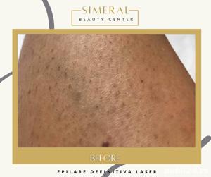 Epilare definitiva laser Brasov salon de infrumusetare  - imagine 3
