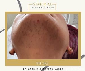 Epilare definitiva laser Brasov salon de infrumusetare 