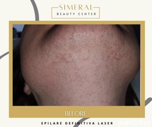 Epilare definitiva laser Brasov salon de infrumusetare  - imagine 9