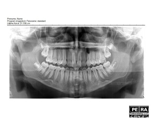 Radiografie Dentara Panoramica Digitala (OPG - Ortopantomograma) Str. Amman, nr. 20, sector 1, Buc.