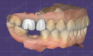 Colaborare pentru design exocad - imagine 3