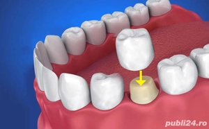 Gratuit tratament dentar