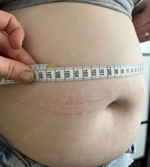 Criolipoliza,Cavitatie,Radiofrecventa,Lipolaser - imagine 4