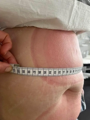 Criolipoliza,Cavitatie,Radiofrecventa,Lipolaser - imagine 5