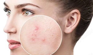 Ai acnee facială și vrei ajutor REAL + bani? 