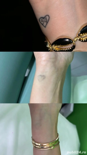 îndepărtare tatuaje 