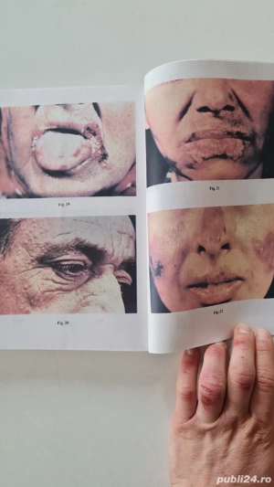 Dermato-venerologie pentru studentii facultatilor de stomatologie Dumitru Justin Diaconu 1998 - imagine 5