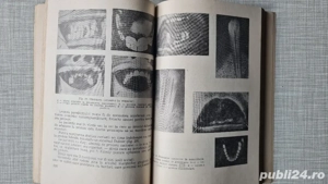 Restaurarea protetica imediata a arcadelor dentare Ion Rindasu 1972 - imagine 4