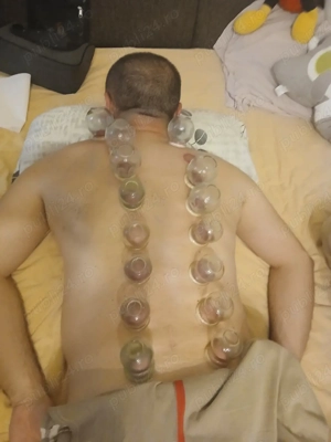 Terapie ventuze cu flacara.