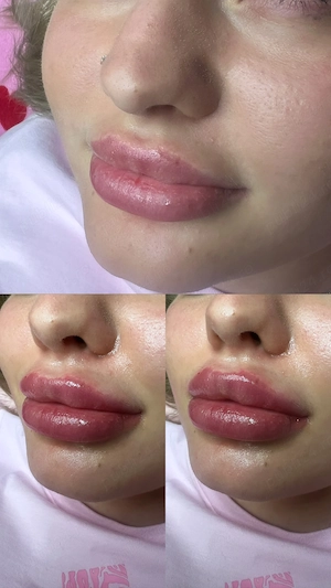 Volumizare buze  - imagine 3