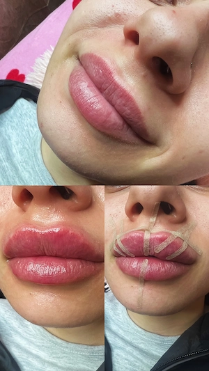 Volumizare buze  - imagine 4