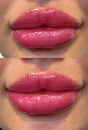 Volumizare buze  - imagine 2