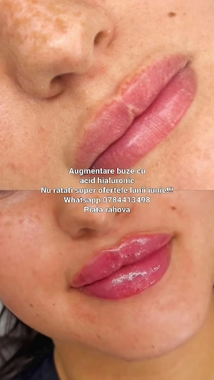 Augmentare buze acid hialuronic
